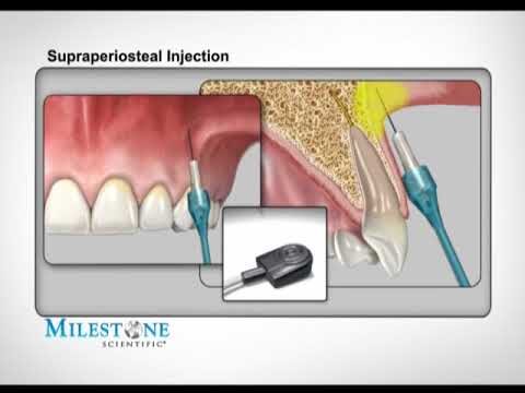 Procedure di Anestesia Dentale: Ottimizzazione e Concisione